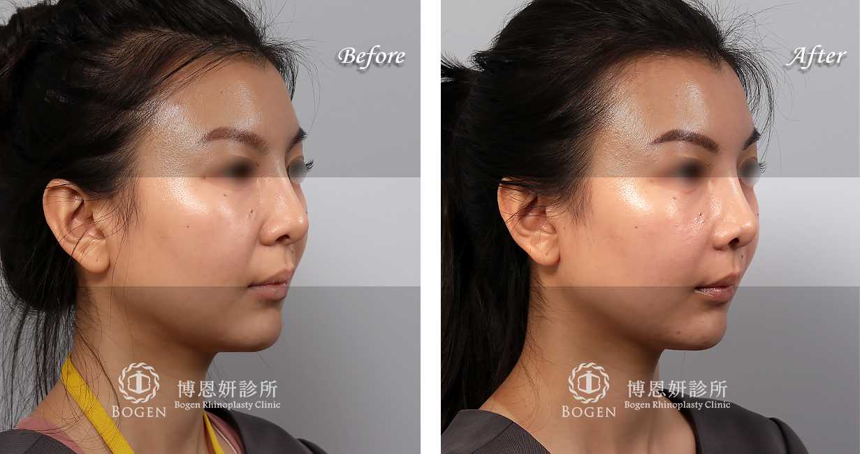 臉部整形手術中，法令紋貴族手術是治療法令紋手術的其中一個環節。有的患者可能曾經利用玻尿酸，電波拉皮治療過法令紋凹陷，或是利用異體真皮粉進行過鼻基底法令紋填充。對於中臉凹陷成有法令紋改善的期望患者，可以考慮利用手法令紋手術來改善。
博恩妍診所法令紋貴族手術均為客製化量身定做，患者前來進行法令紋面診時均會利用3D電腦斷層進行法令紋中臉凹陷的評估，並詳細解釋不論是人工植體或是異體真皮貴族手術的材質差異。讓患者確實理解手術效果後再進行手術。