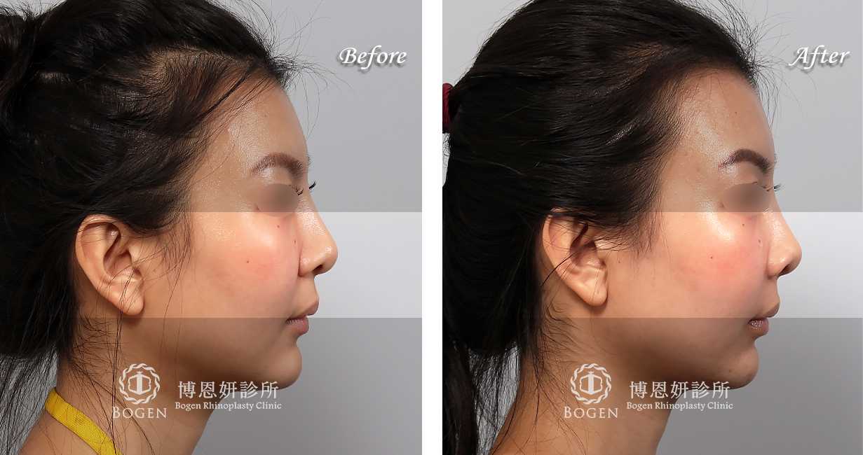 臉部整形手術中，法令紋貴族手術是治療法令紋手術的其中一個環節。有的患者可能曾經利用玻尿酸，電波拉皮治療過法令紋凹陷，或是利用異體真皮粉進行過鼻基底法令紋填充。對於中臉凹陷成有法令紋改善的期望患者，可以考慮利用手法令紋手術來改善。
博恩妍診所法令紋貴族手術均為客製化量身定做，患者前來進行法令紋面診時均會利用3D電腦斷層進行法令紋中臉凹陷的評估，並詳細解釋不論是人工植體或是異體真皮貴族手術的材質差異。讓患者確實理解手術效果後再進行手術。