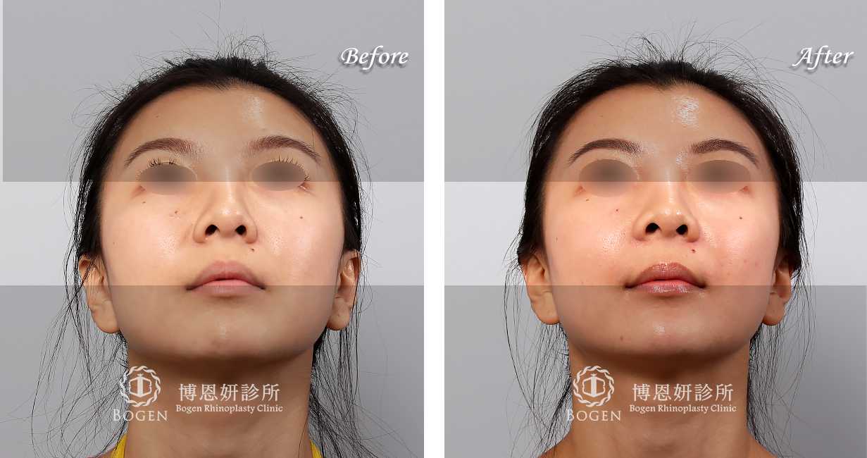 臉部整形手術中，法令紋貴族手術是治療法令紋手術的其中一個環節。有的患者可能曾經利用玻尿酸，電波拉皮治療過法令紋凹陷，或是利用異體真皮粉進行過鼻基底法令紋填充。對於中臉凹陷成有法令紋改善的期望患者，可以考慮利用手法令紋手術來改善。
博恩妍診所法令紋貴族手術均為客製化量身定做，患者前來進行法令紋面診時均會利用3D電腦斷層進行法令紋中臉凹陷的評估，並詳細解釋不論是人工植體或是異體真皮貴族手術的材質差異。讓患者確實理解手術效果後再進行手術。